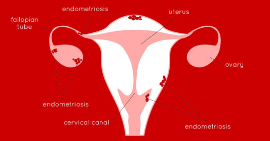 Can I Use A Menstrual Cup If I Have Endometriosis?