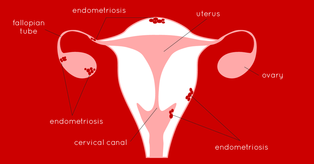 Can I Use A Menstrual Cup If I Have Endometriosis?
