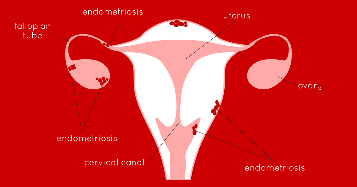 Can I Use A Menstrual Cup If I Have Endometriosis?